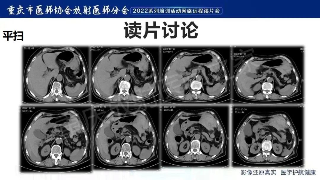 影像PPT - 【病例】腹腔胃大弯旁血肿1例CT影像-3
