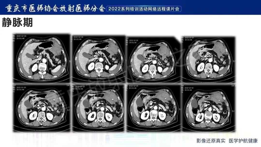 影像PPT - 【病例】腹腔胃大弯旁血肿1例CT影像-5