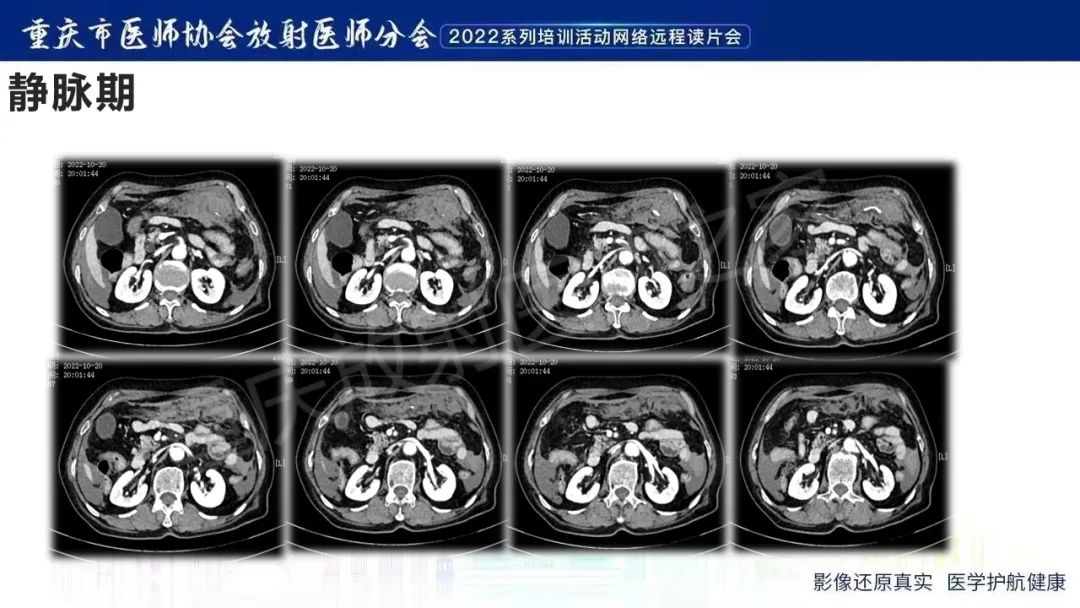 影像PPT - 【病例】腹腔胃大弯旁血肿1例CT影像-6