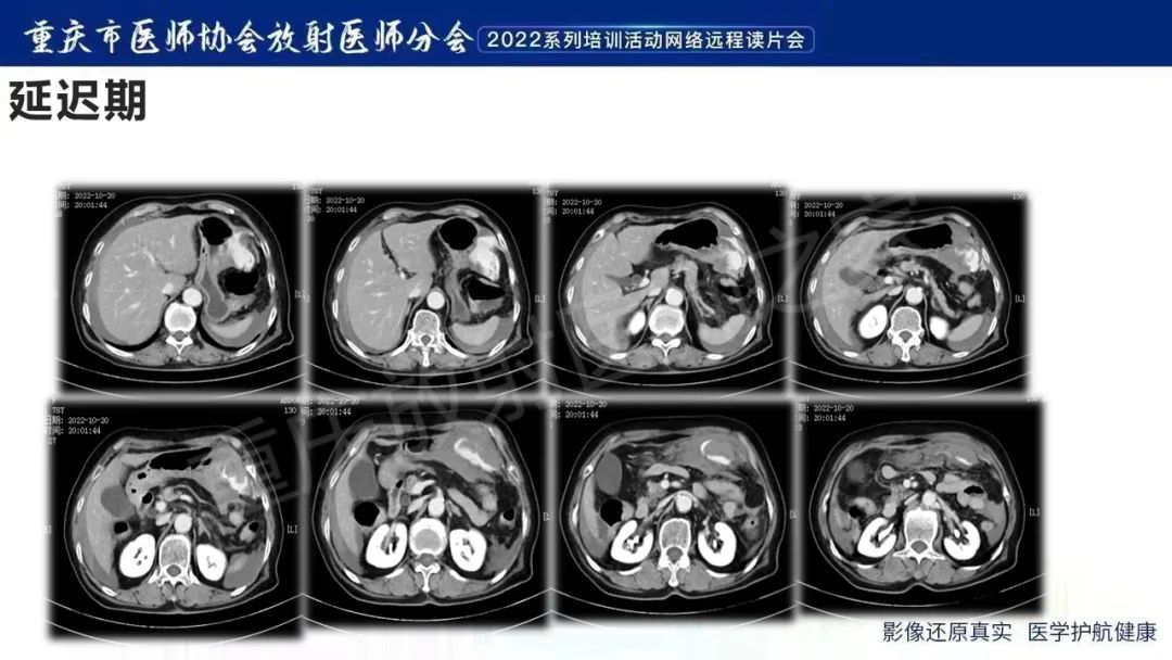 影像PPT - 【病例】腹腔胃大弯旁血肿1例CT影像-7