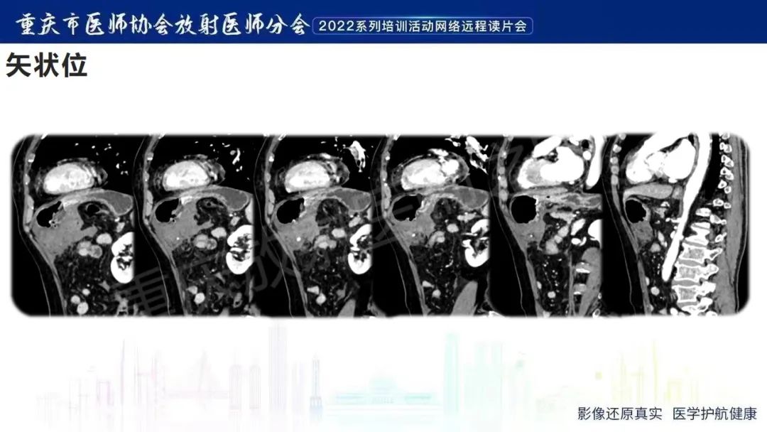 影像PPT - 【病例】腹腔胃大弯旁血肿1例CT影像-8