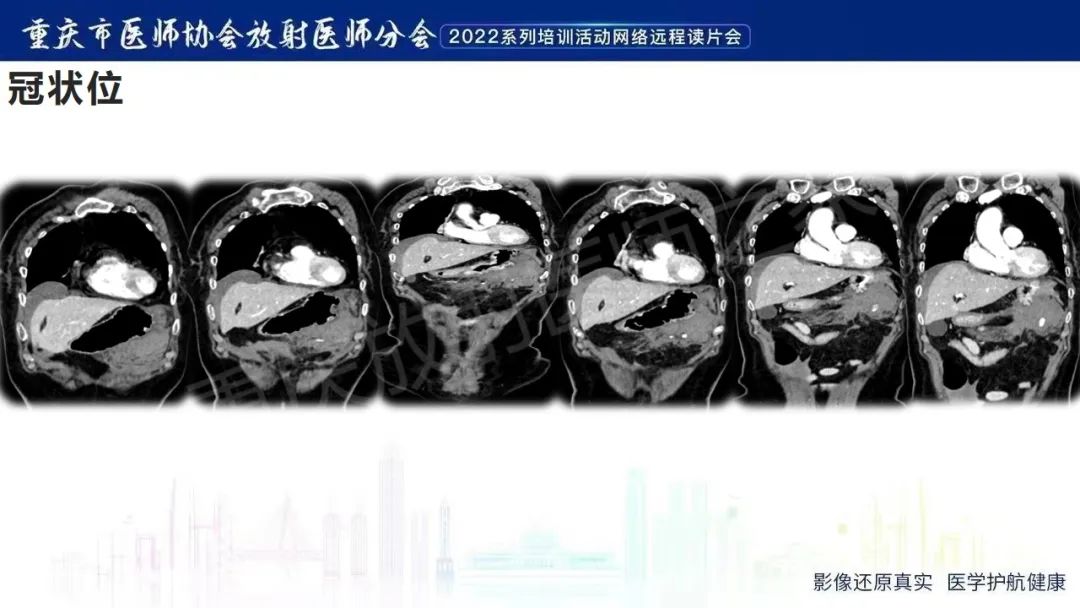 影像PPT - 【病例】腹腔胃大弯旁血肿1例CT影像-9