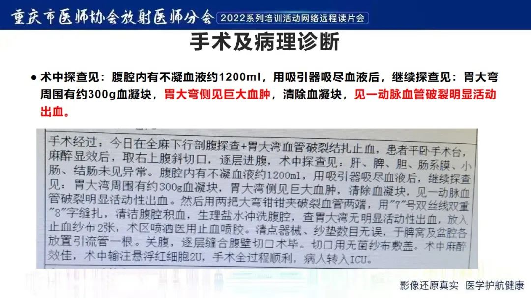 影像PPT - 【病例】腹腔胃大弯旁血肿1例CT影像-11