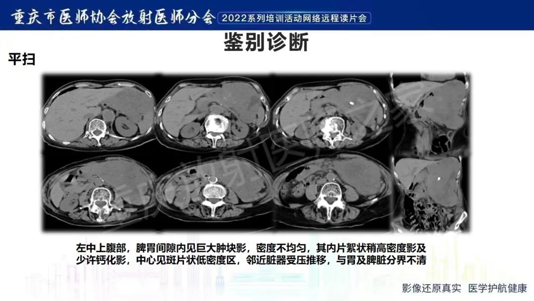 影像PPT - 【病例】腹腔胃大弯旁血肿1例CT影像-16
