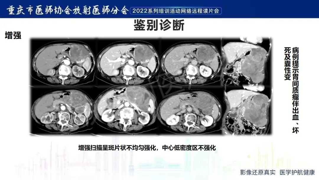 影像PPT - 【病例】腹腔胃大弯旁血肿1例CT影像-17