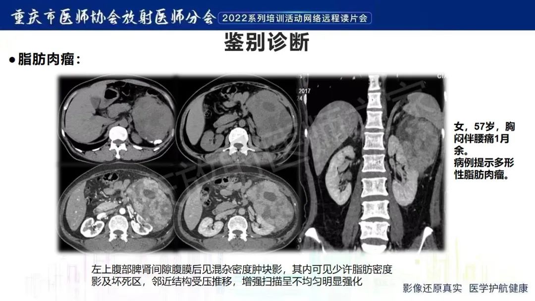 影像PPT - 【病例】腹腔胃大弯旁血肿1例CT影像-19