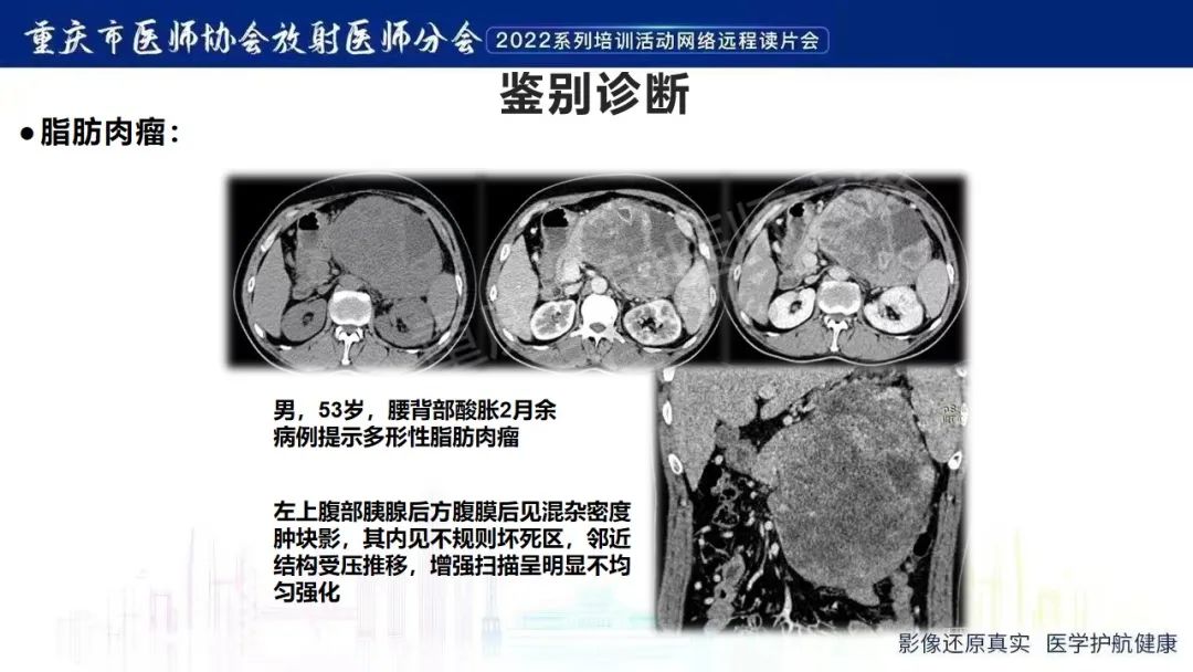 影像PPT - 【病例】腹腔胃大弯旁血肿1例CT影像-20