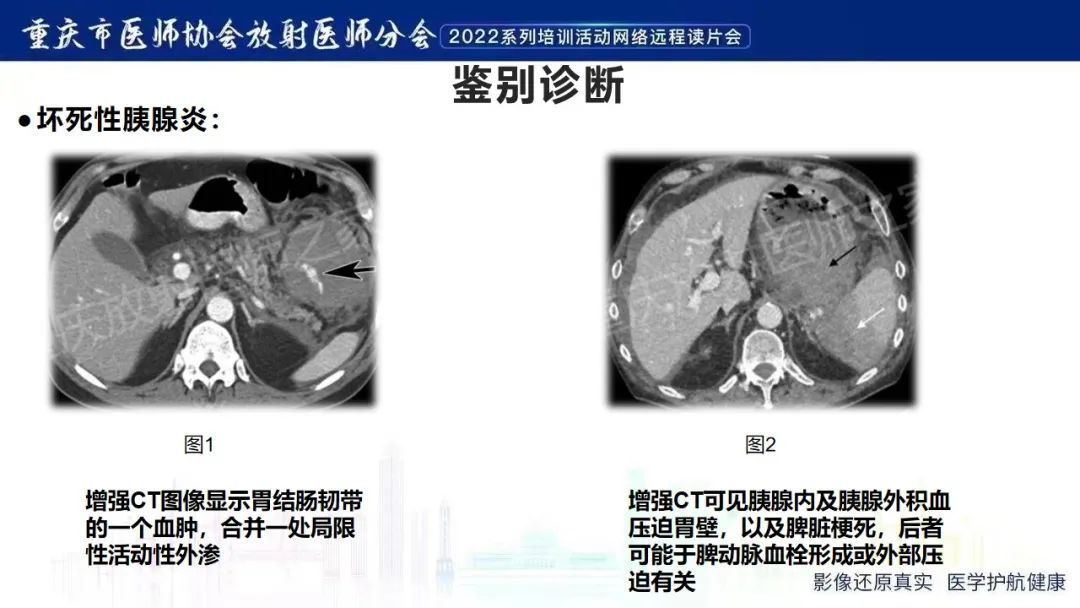 影像PPT - 【病例】腹腔胃大弯旁血肿1例CT影像-22