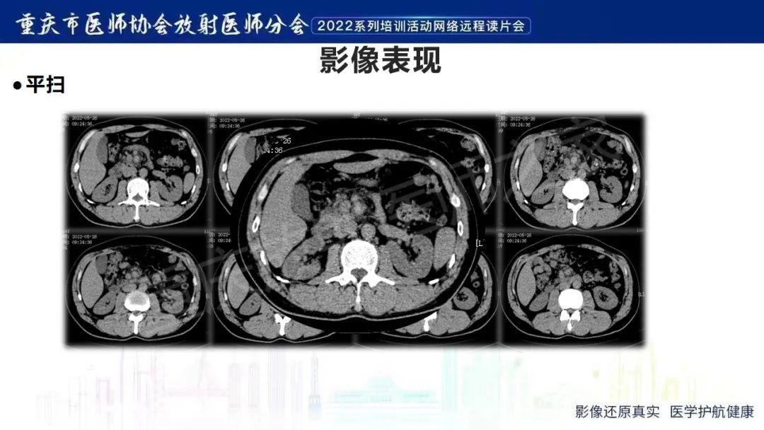 影像PPT - 【病例】腹腔胃大弯旁血肿1例CT影像-23