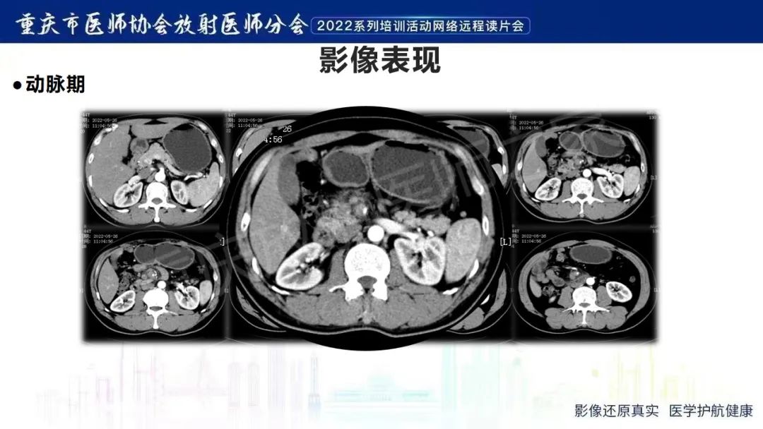 影像PPT - 【病例】腹腔胃大弯旁血肿1例CT影像-25