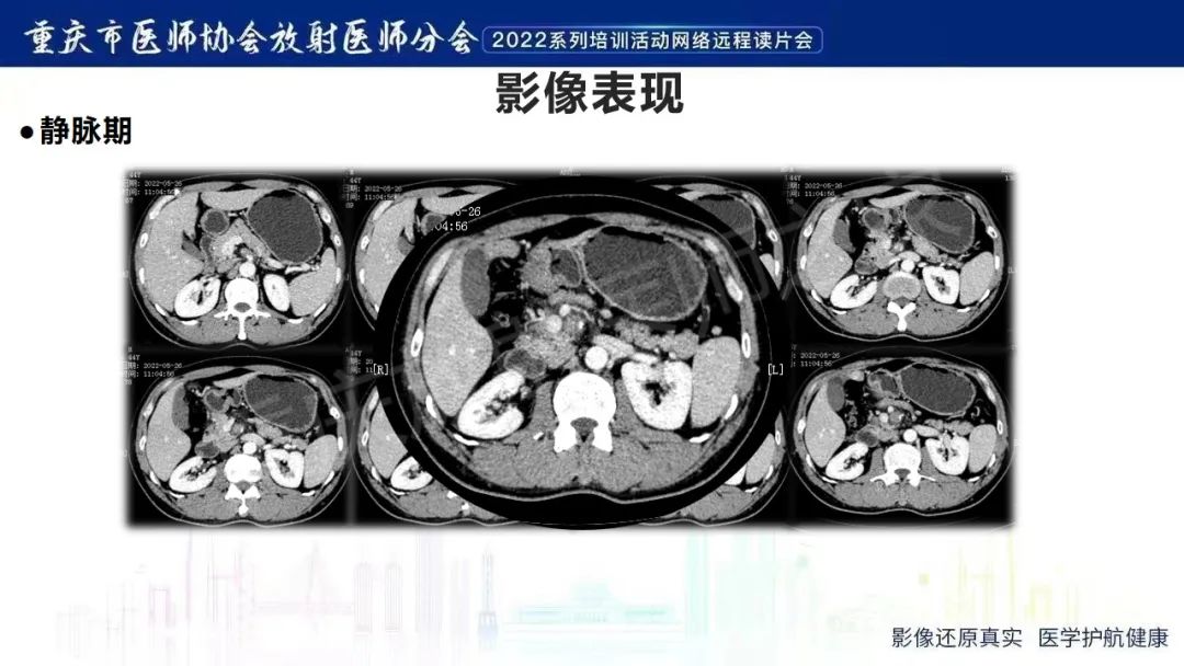 影像PPT - 【病例】腹腔胃大弯旁血肿1例CT影像-26