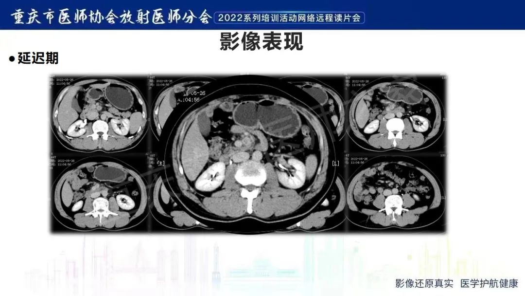 影像PPT - 【病例】腹腔胃大弯旁血肿1例CT影像-27