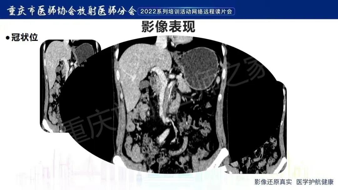 影像PPT - 【病例】腹腔胃大弯旁血肿1例CT影像-28