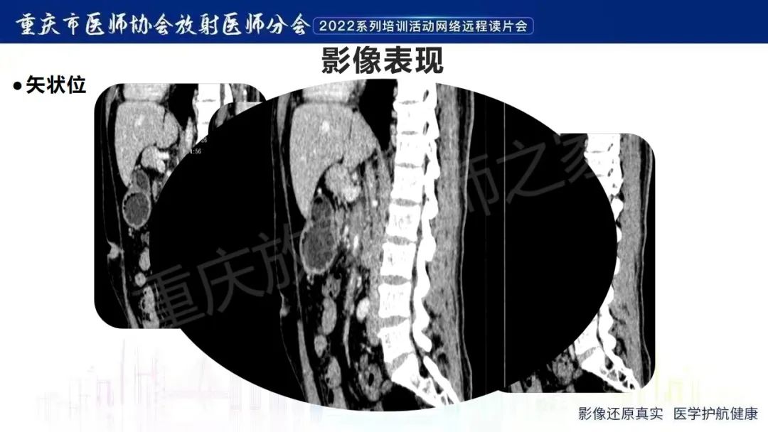 影像PPT - 【病例】腹腔胃大弯旁血肿1例CT影像-29