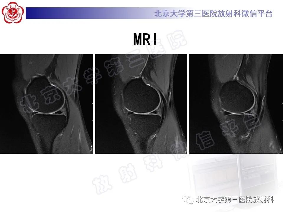 影像PPT - 【PPT】半月板撕裂的影像学诊断-3