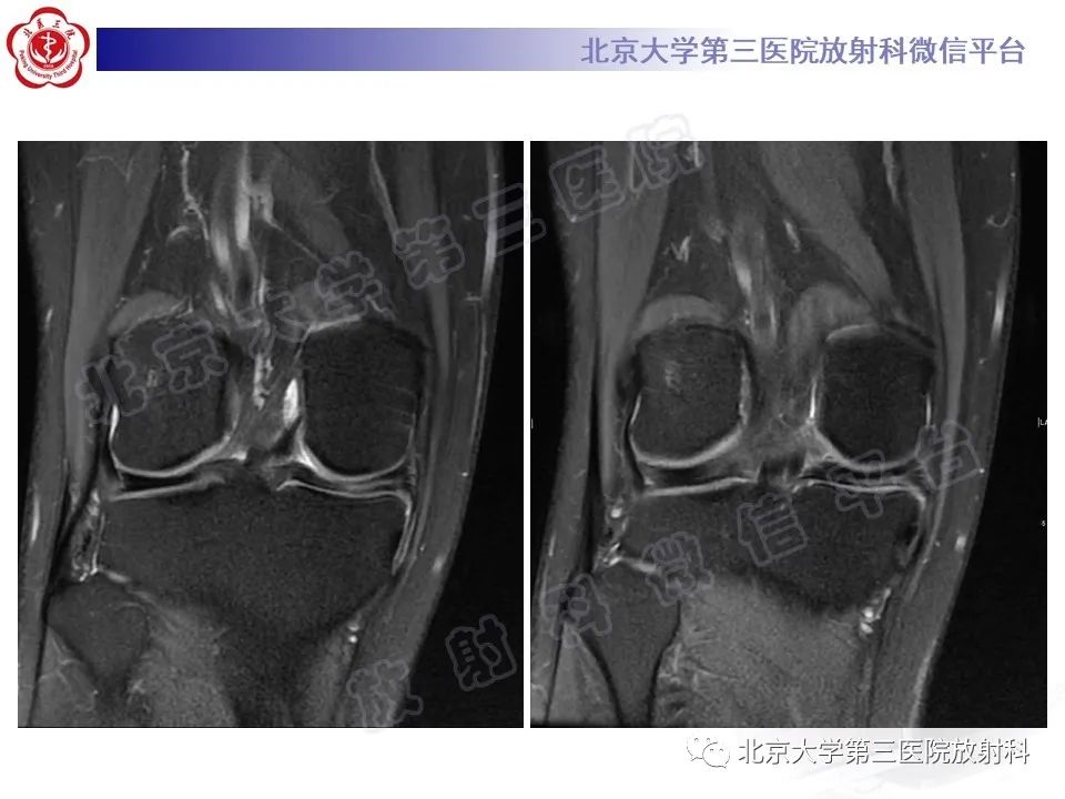 影像PPT - 【PPT】半月板撕裂的影像学诊断-4
