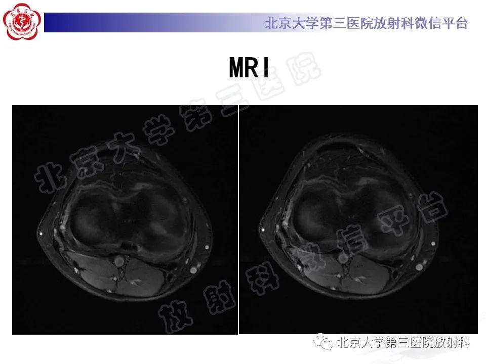 影像PPT - 【PPT】半月板撕裂的影像学诊断-5