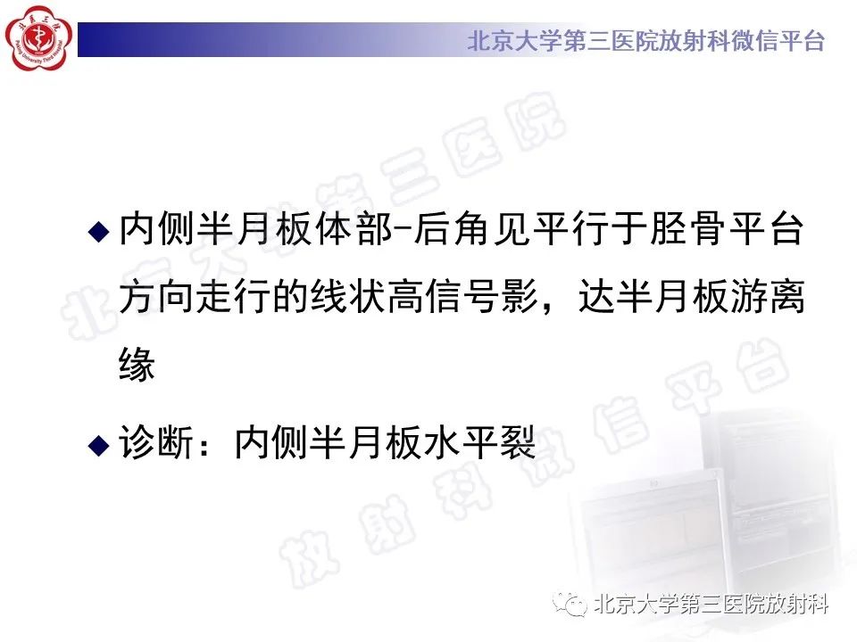 影像PPT - 【PPT】半月板撕裂的影像学诊断-6