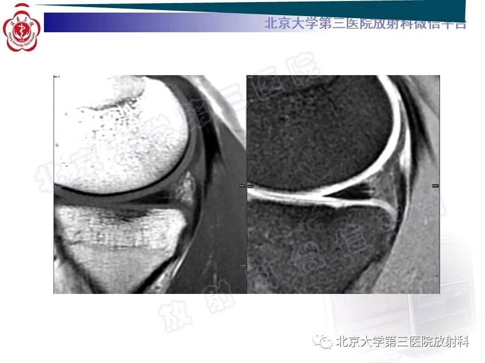 影像PPT - 【PPT】半月板撕裂的影像学诊断-9