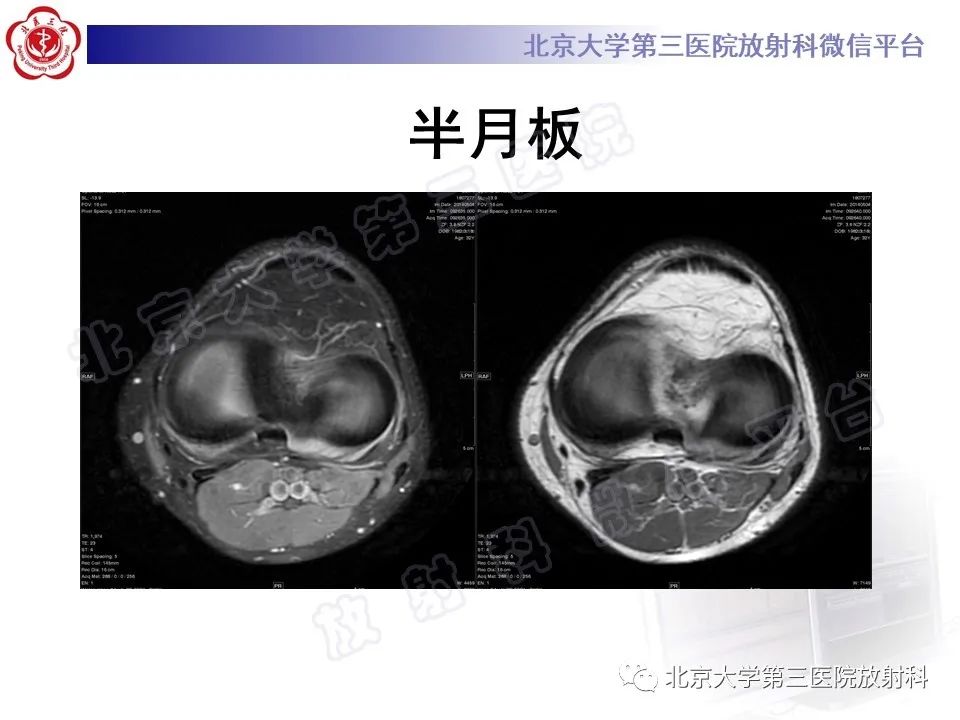 影像PPT - 【PPT】半月板撕裂的影像学诊断-8