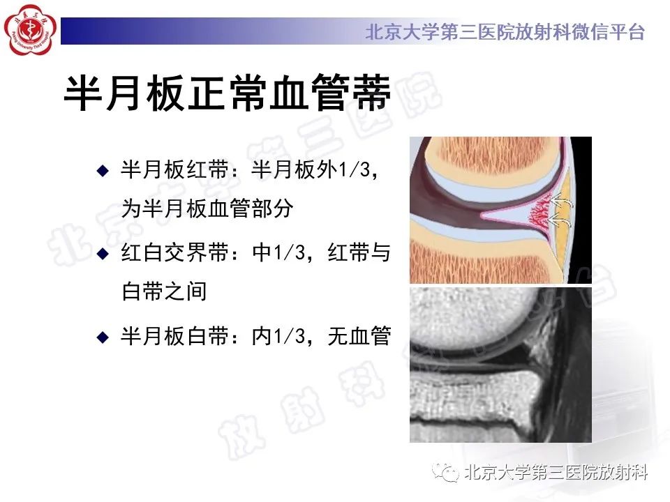 影像PPT - 【PPT】半月板撕裂的影像学诊断-10