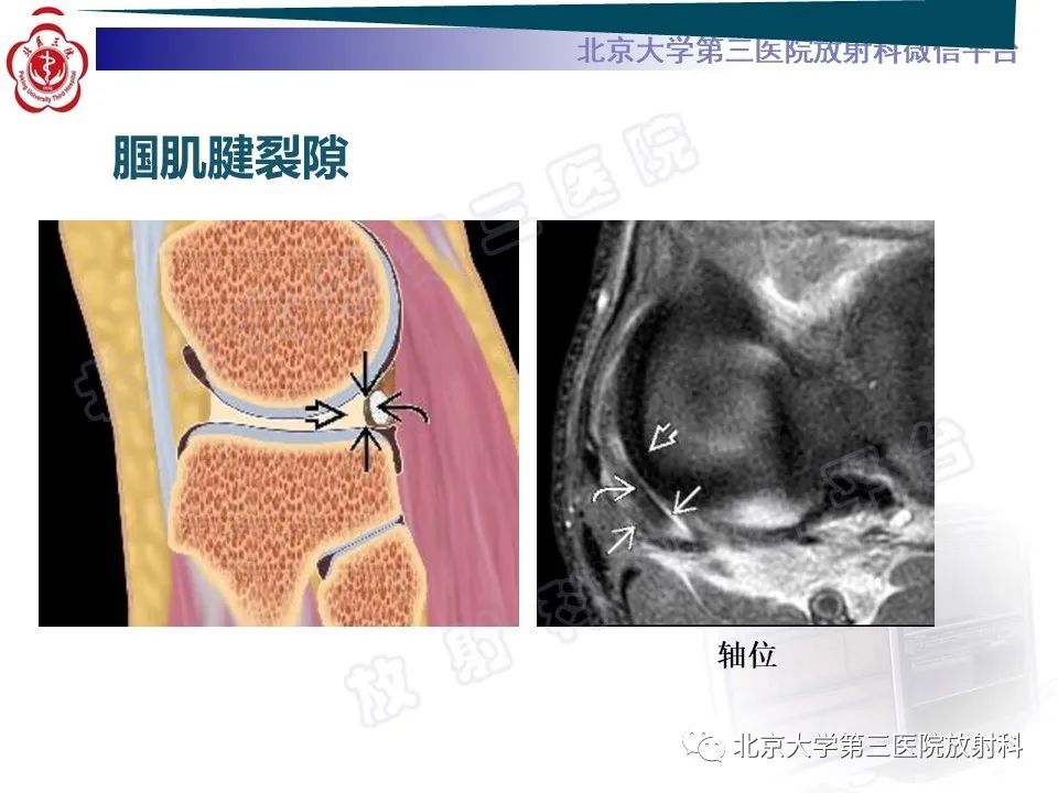 影像PPT - 【PPT】半月板撕裂的影像学诊断-11