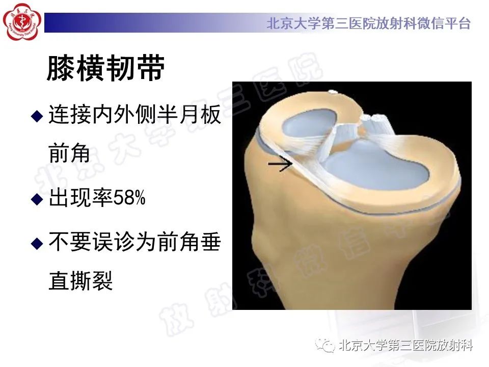 影像PPT - 【PPT】半月板撕裂的影像学诊断-12