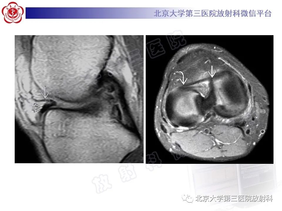 影像PPT - 【PPT】半月板撕裂的影像学诊断-13