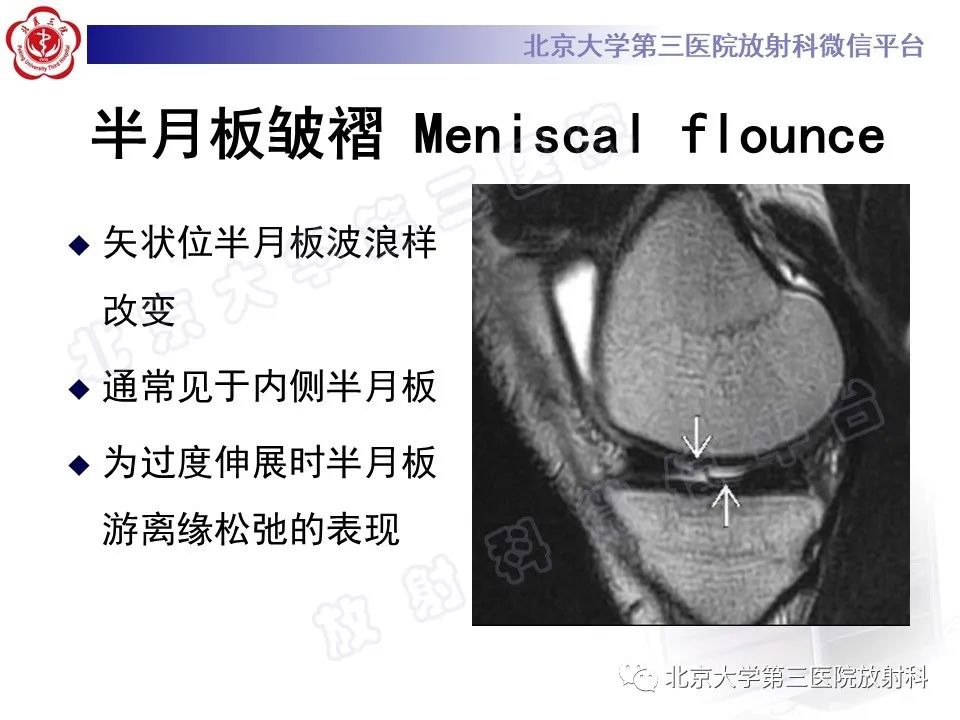 影像PPT - 【PPT】半月板撕裂的影像学诊断-14