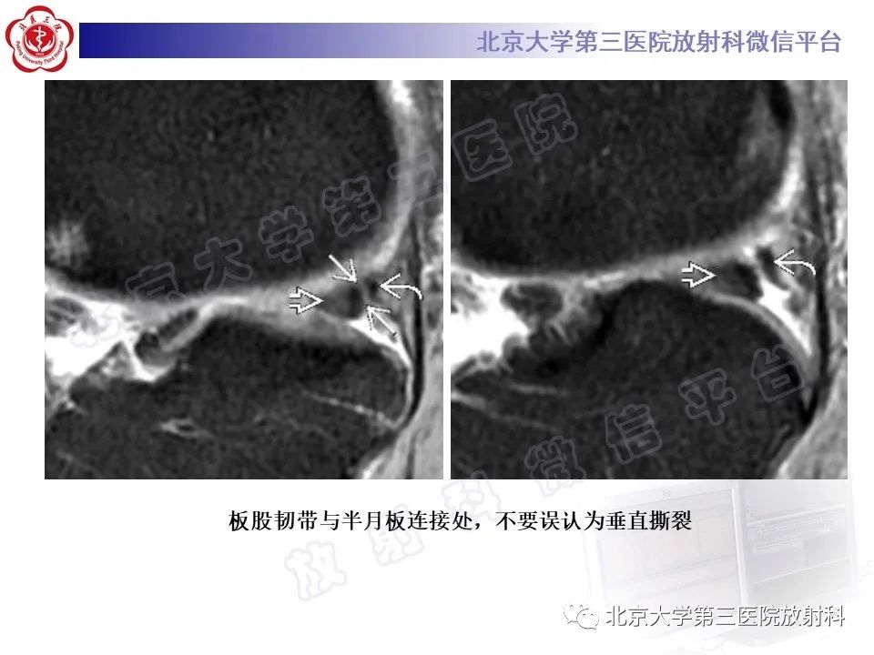 影像PPT - 【PPT】半月板撕裂的影像学诊断-16