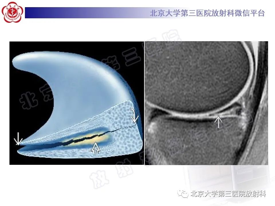 影像PPT - 【PPT】半月板撕裂的影像学诊断-19