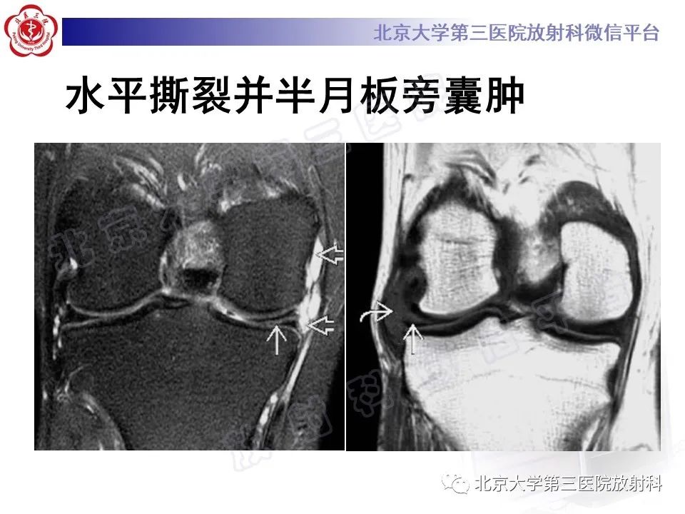 影像PPT - 【PPT】半月板撕裂的影像学诊断-20