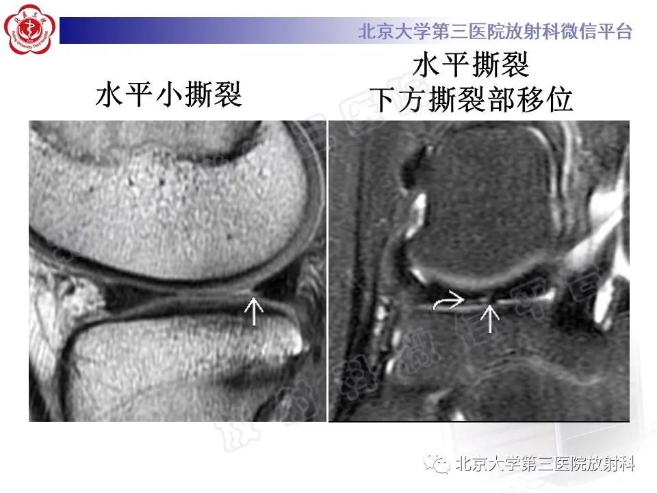 影像PPT - 【PPT】半月板撕裂的影像学诊断-21