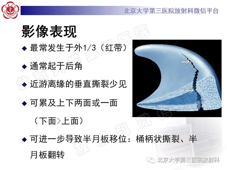 影像PPT - 【PPT】半月板撕裂的影像学诊断-23