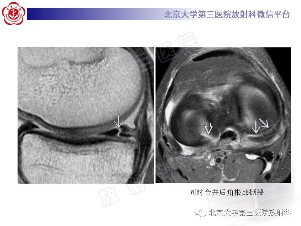 影像PPT - 【PPT】半月板撕裂的影像学诊断-24