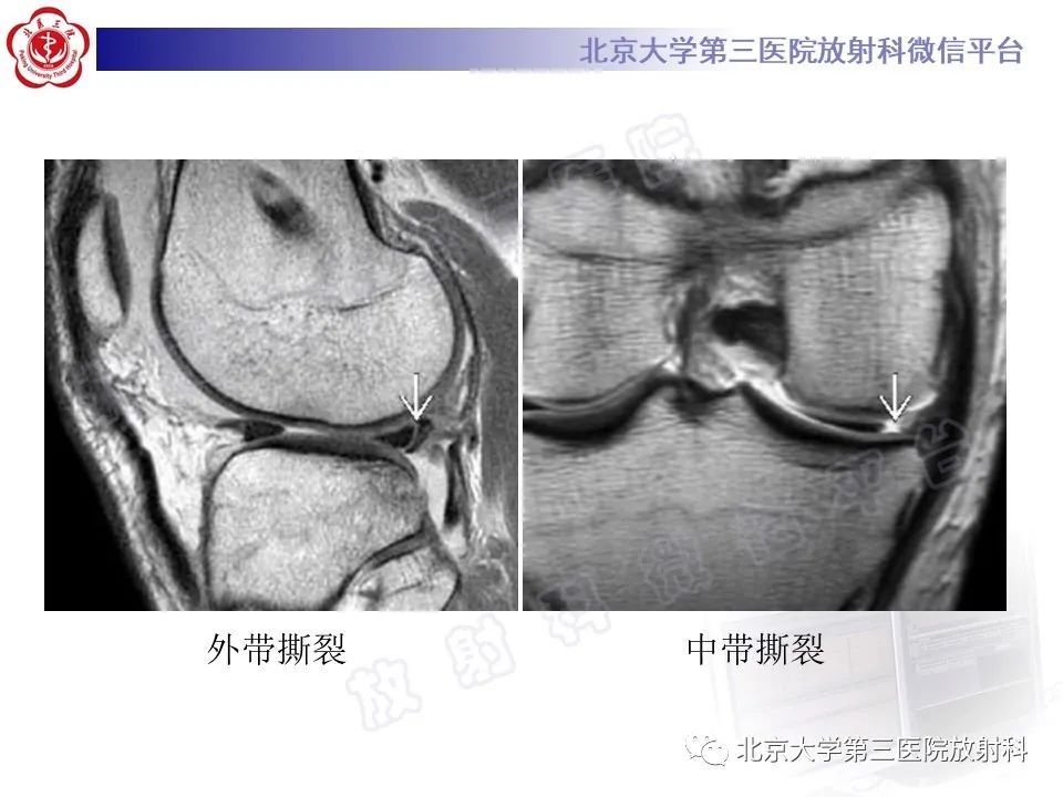 影像PPT - 【PPT】半月板撕裂的影像学诊断-25