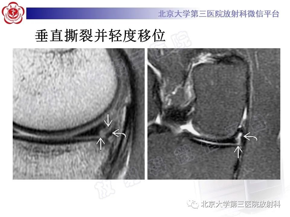 影像PPT - 【PPT】半月板撕裂的影像学诊断-26