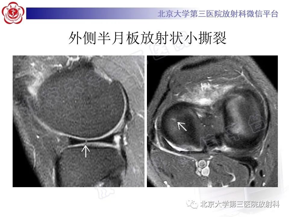影像PPT - 【PPT】半月板撕裂的影像学诊断-31