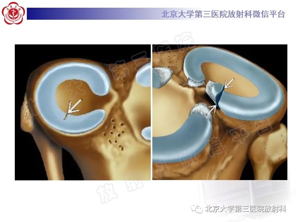 影像PPT - 【PPT】半月板撕裂的影像学诊断-30