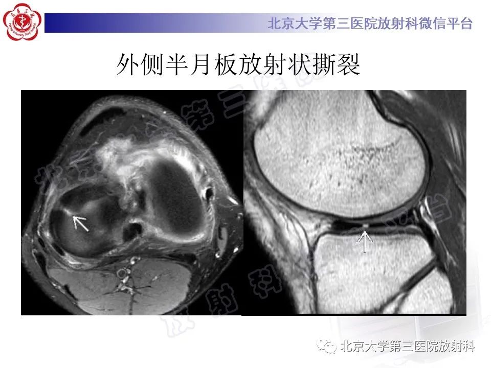 影像PPT - 【PPT】半月板撕裂的影像学诊断-32