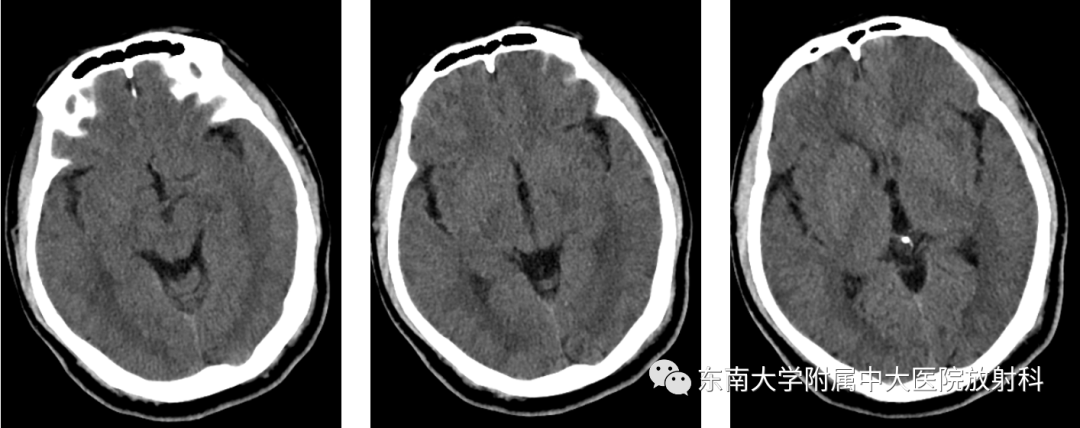 影像PPT - 【PPT】肝性脑病的影像学表现-1