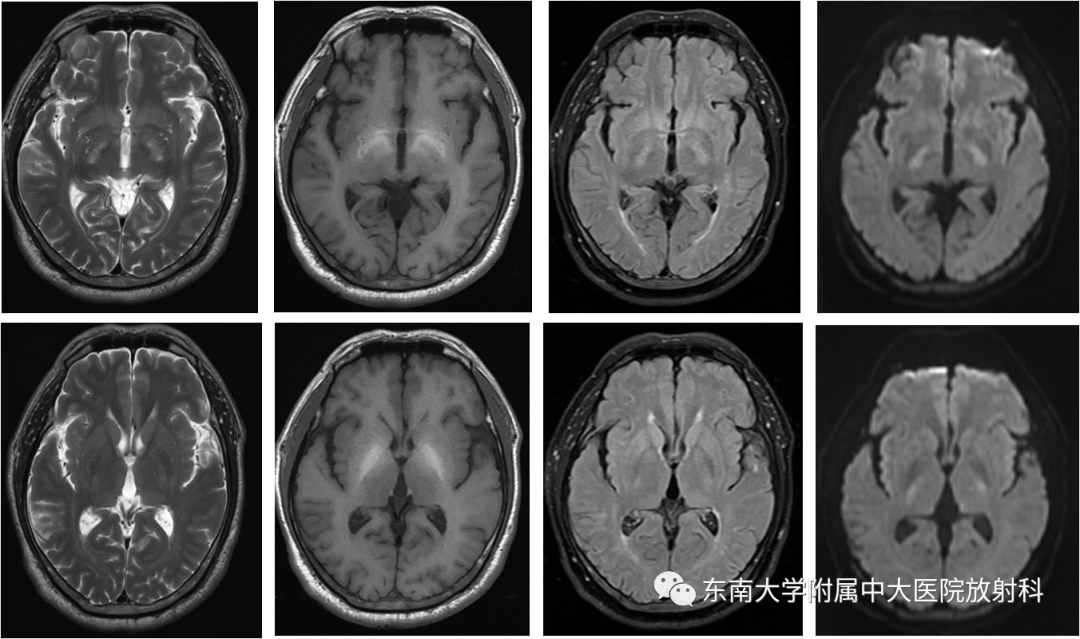 影像PPT - 【PPT】肝性脑病的影像学表现-2