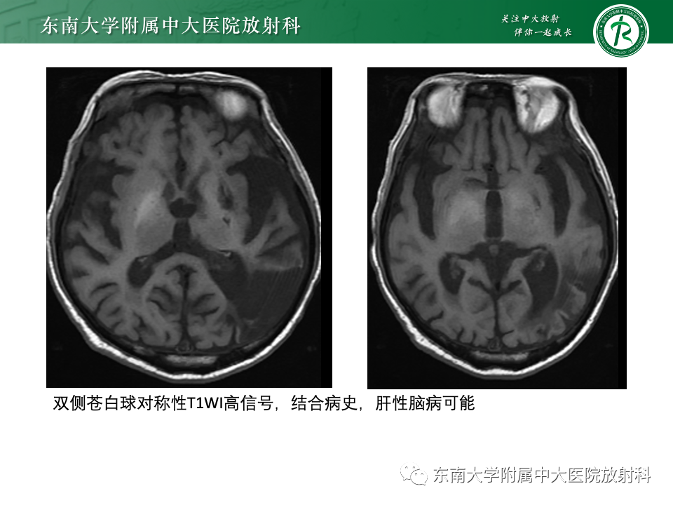 影像PPT - 【PPT】肝性脑病的影像学表现-14