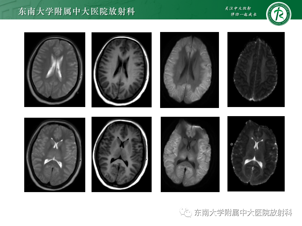 影像PPT - 【PPT】肝性脑病的影像学表现-16