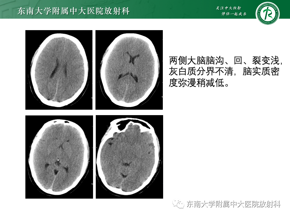 影像PPT - 【PPT】肝性脑病的影像学表现-15