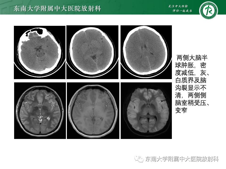 影像PPT - 【PPT】肝性脑病的影像学表现-17
