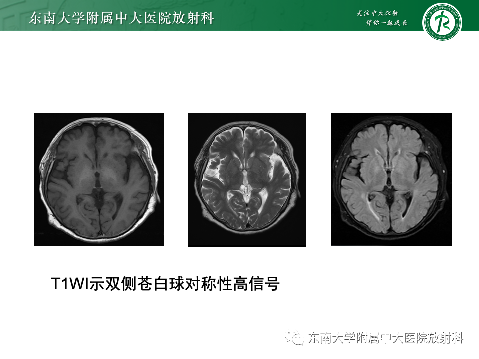 影像PPT - 【PPT】肝性脑病的影像学表现-22