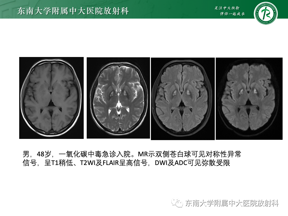 影像PPT - 【PPT】肝性脑病的影像学表现-27
