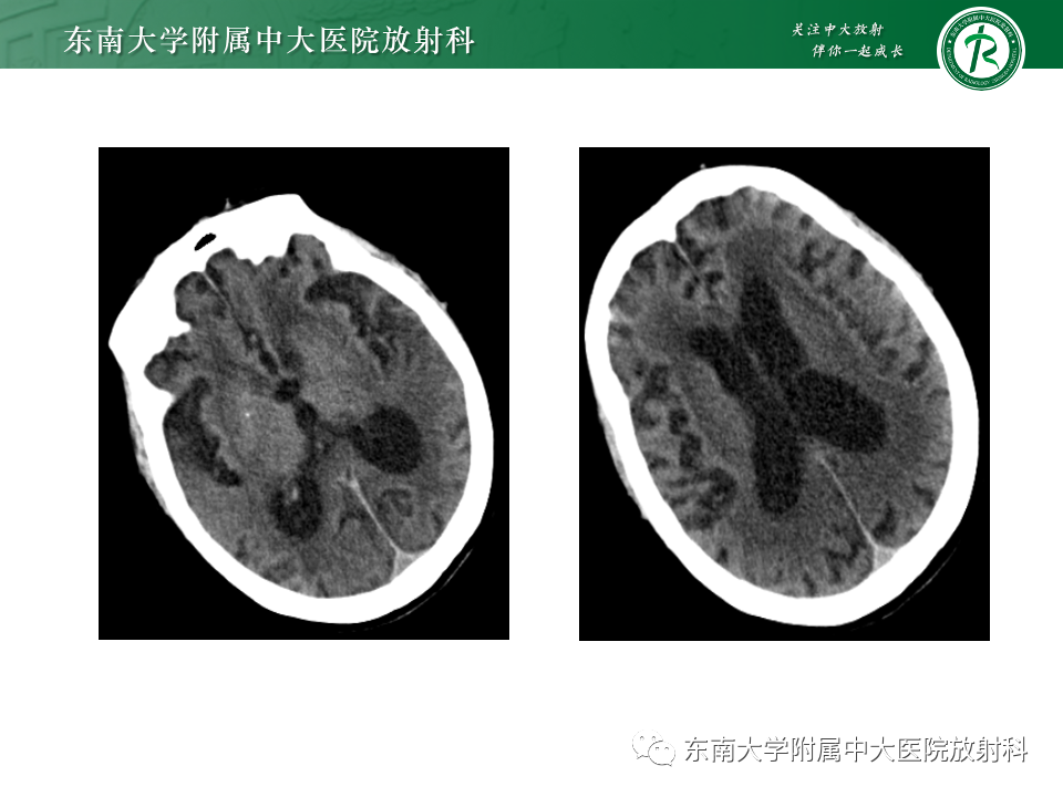 影像PPT - 【PPT】肝性脑病的影像学表现-30