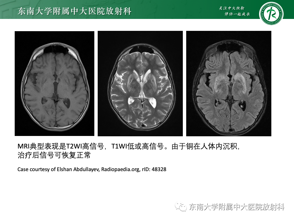 影像PPT - 【PPT】肝性脑病的影像学表现-29